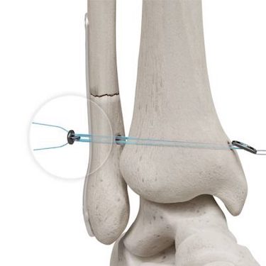 Conventus Flower Orthopedics – Conventus Flower Orthopedics